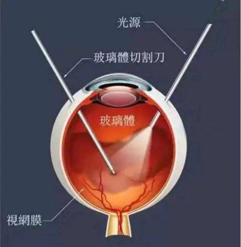 玻璃体切割手术