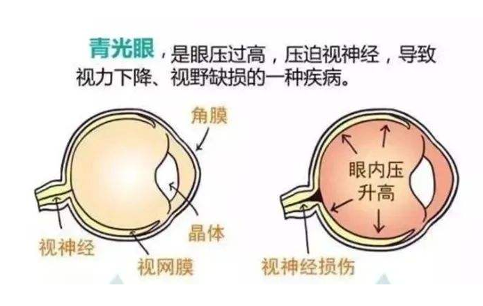 青光眼与白内障联合手术