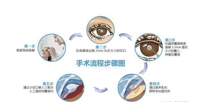 超声乳化+人工晶体植入
