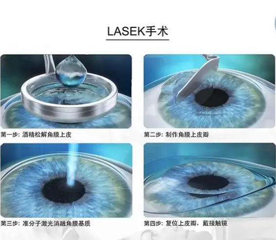 准分子激光