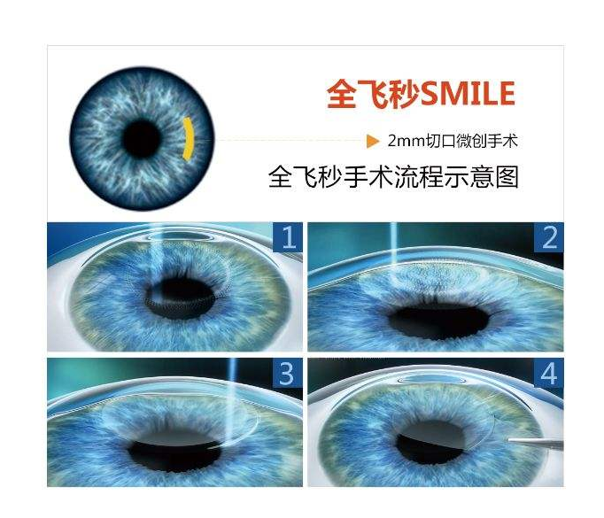 全飞秒激光