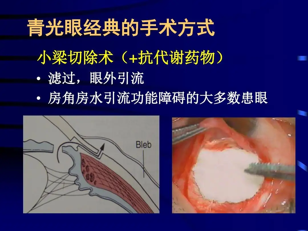复合式小梁切除术
