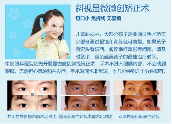 斜视矫正手术