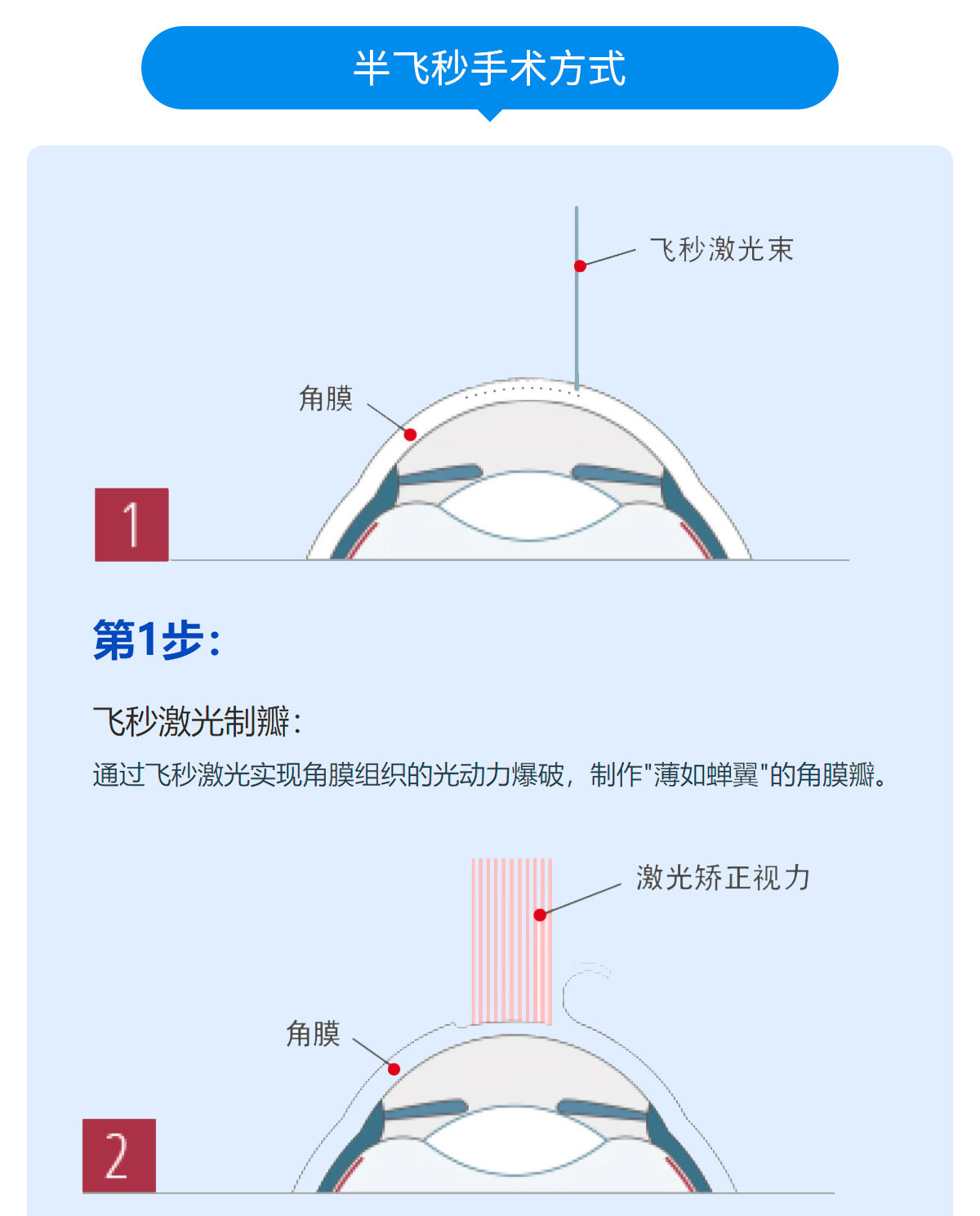 重庆哪个医生做近视手术最好眼科医院前三甲,飞秒价格,飞秒几天才能恢复_患者_情况_眼睛